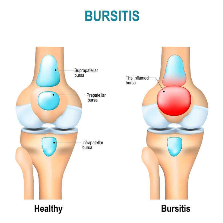 Knee bursitis graphic – causes of knee pain